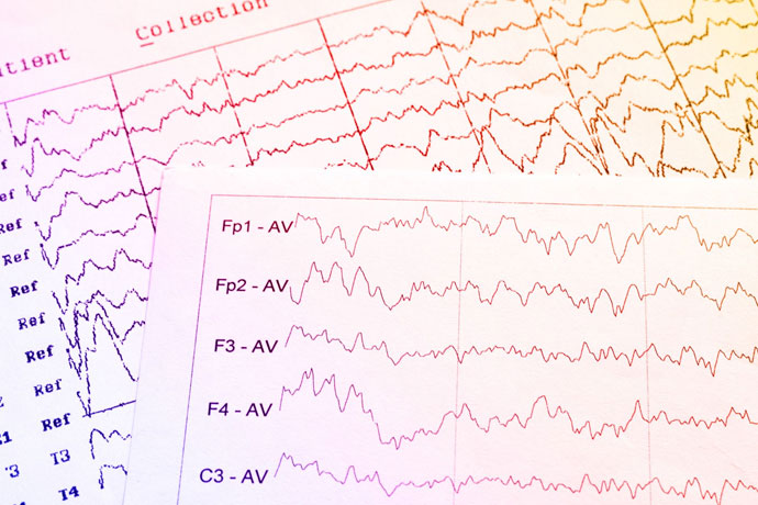 رسم المخ الكهربائي (EEG) أو مخطط كهربية الدماغ (Electroencephalogram) إِبْی لِبْسی